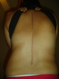 Adult Scoliosis Surgery