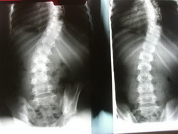 Scoliosis Surgery Adults