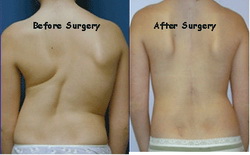 Scoliosis Surgery Complications