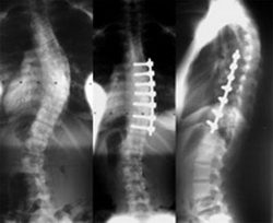 Scoliosis Surgery Cost