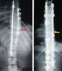 Scoliosis Surgery Procedure