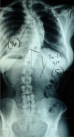 Scoliosis Surgery Stories