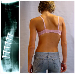Scoliosis Surgery