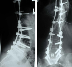 Spinal Scoliosis Surgery
